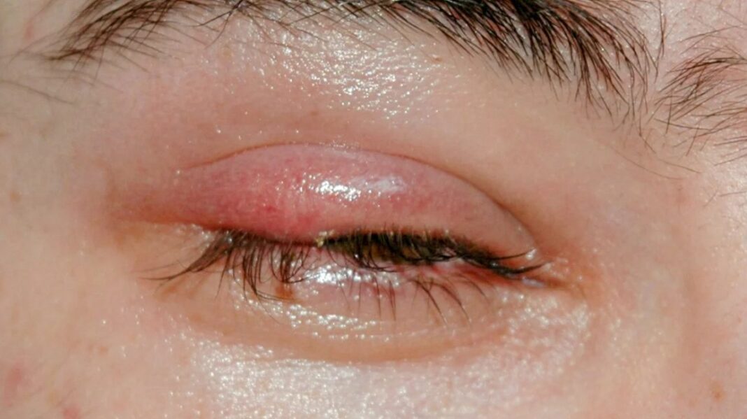 stye treatment antibiotic
